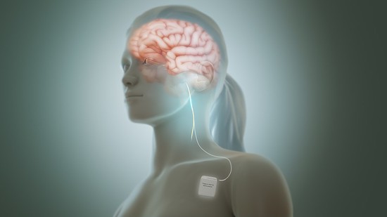 Vagal Nerve Stimulation